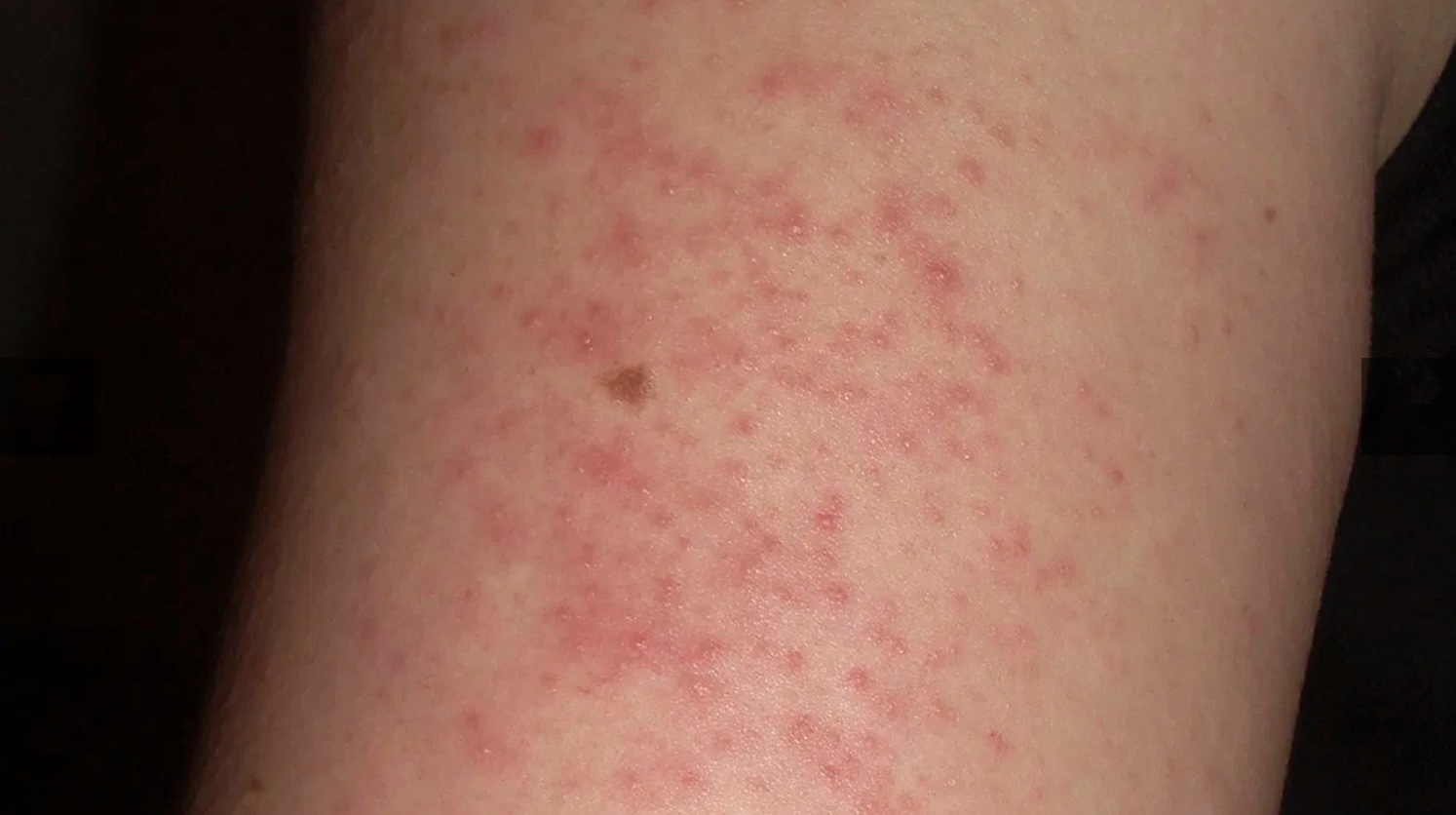 What Can Cause Red Dots To Appear On The Skin Retiree News